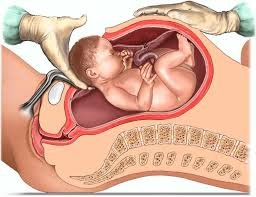 C Section